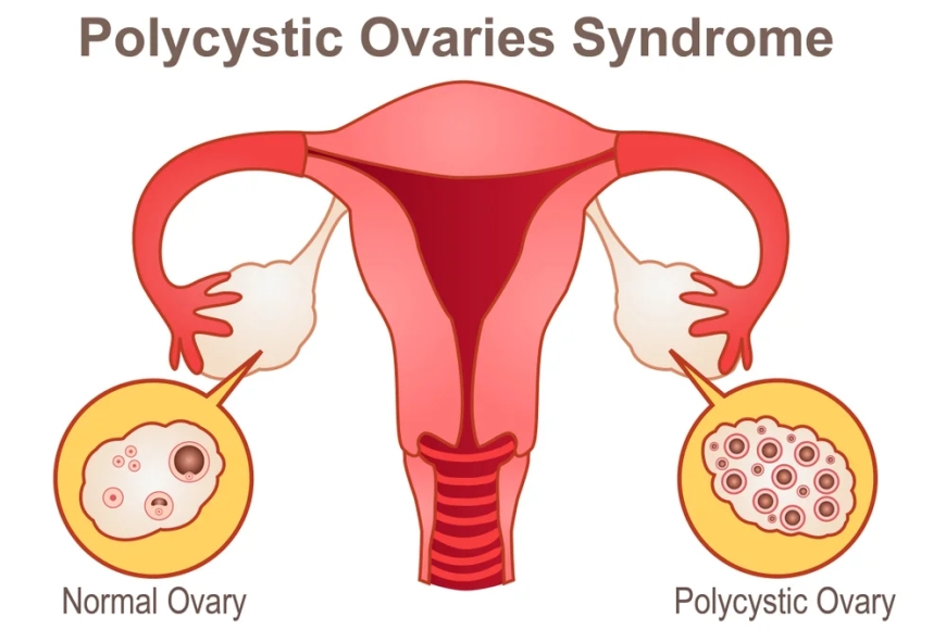 Bilateral Polycystic Ovarian Syndrome - Khichdi Network Portal