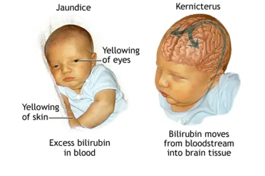 presentation of kernicterus