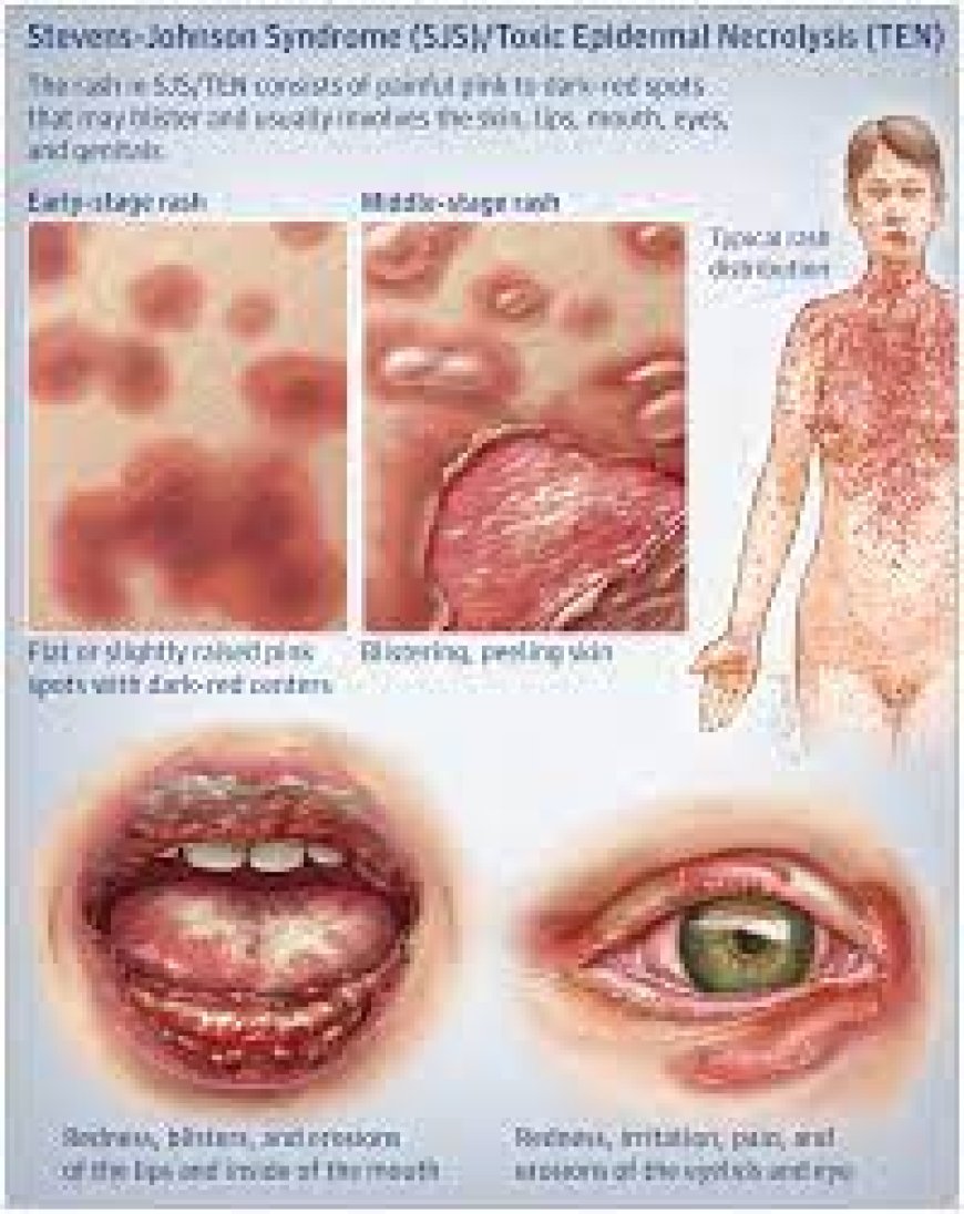 Johnson-Stevens Disease