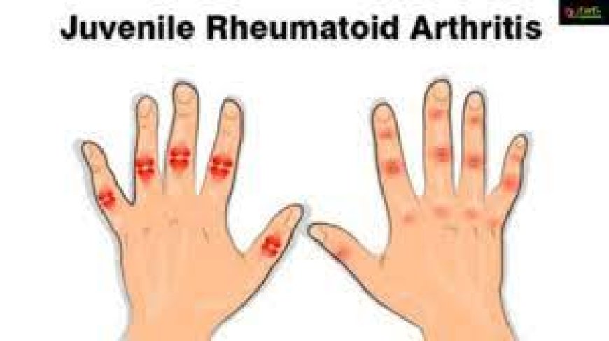 Juvenile Rheumatoid Arthritis (JRA)