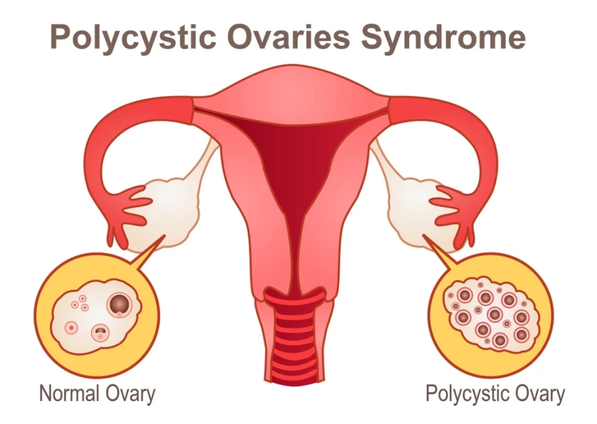 Bilateral Polycystic Ovarian Syndrome