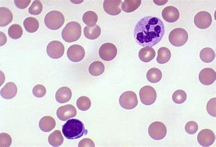 Folate Deficiency Anemia- Rare Types of Anemia