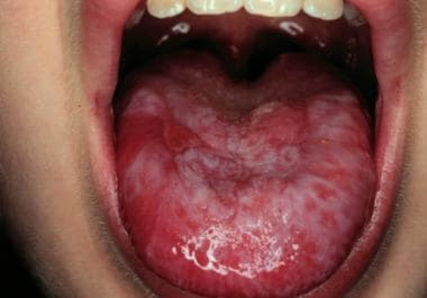 Idiopathic Aplastic anemia