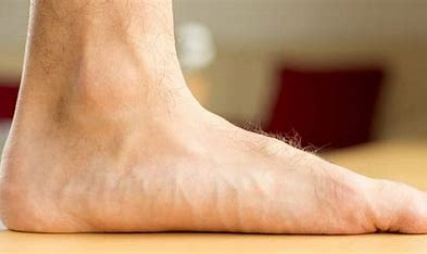 Flatfoot (Pes Planus)