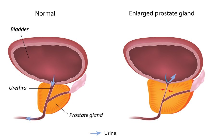 Benign Prostatic Enlargement( BPH)