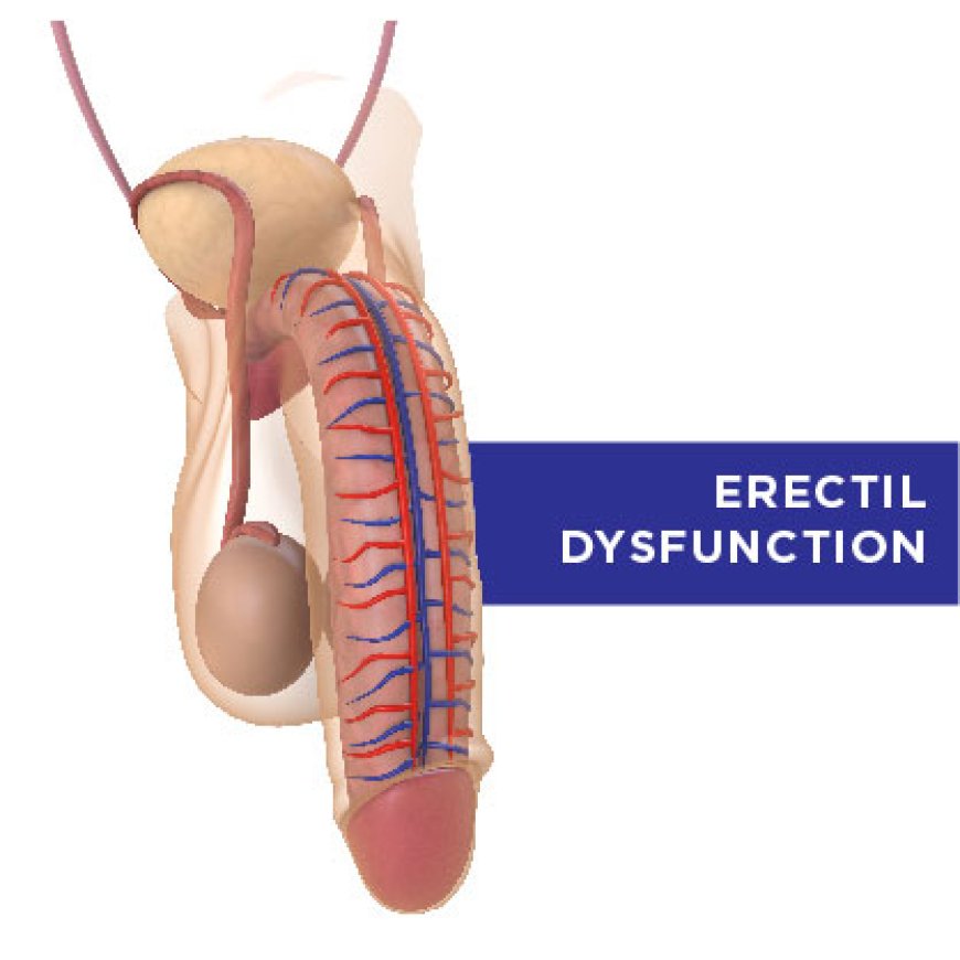 Impotence (Erectile dysfunction)