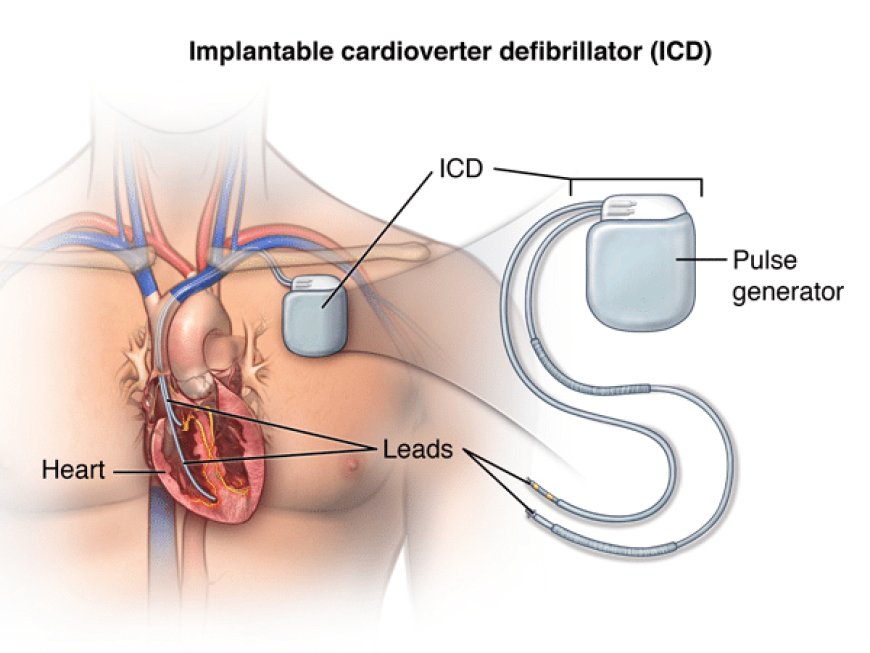 Implantable Cardioverter Defibrillator ICD