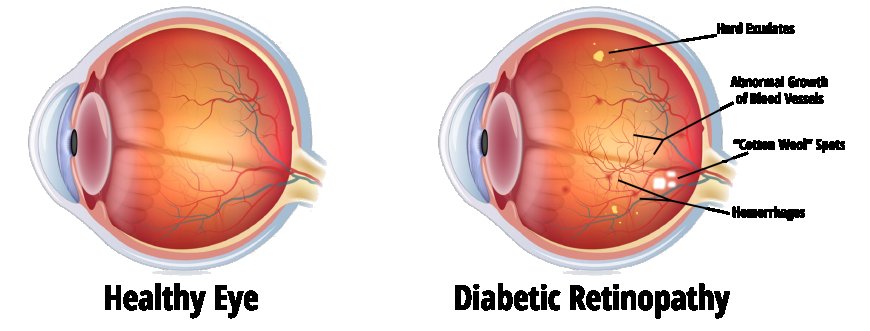 Diabetic Eye Disease