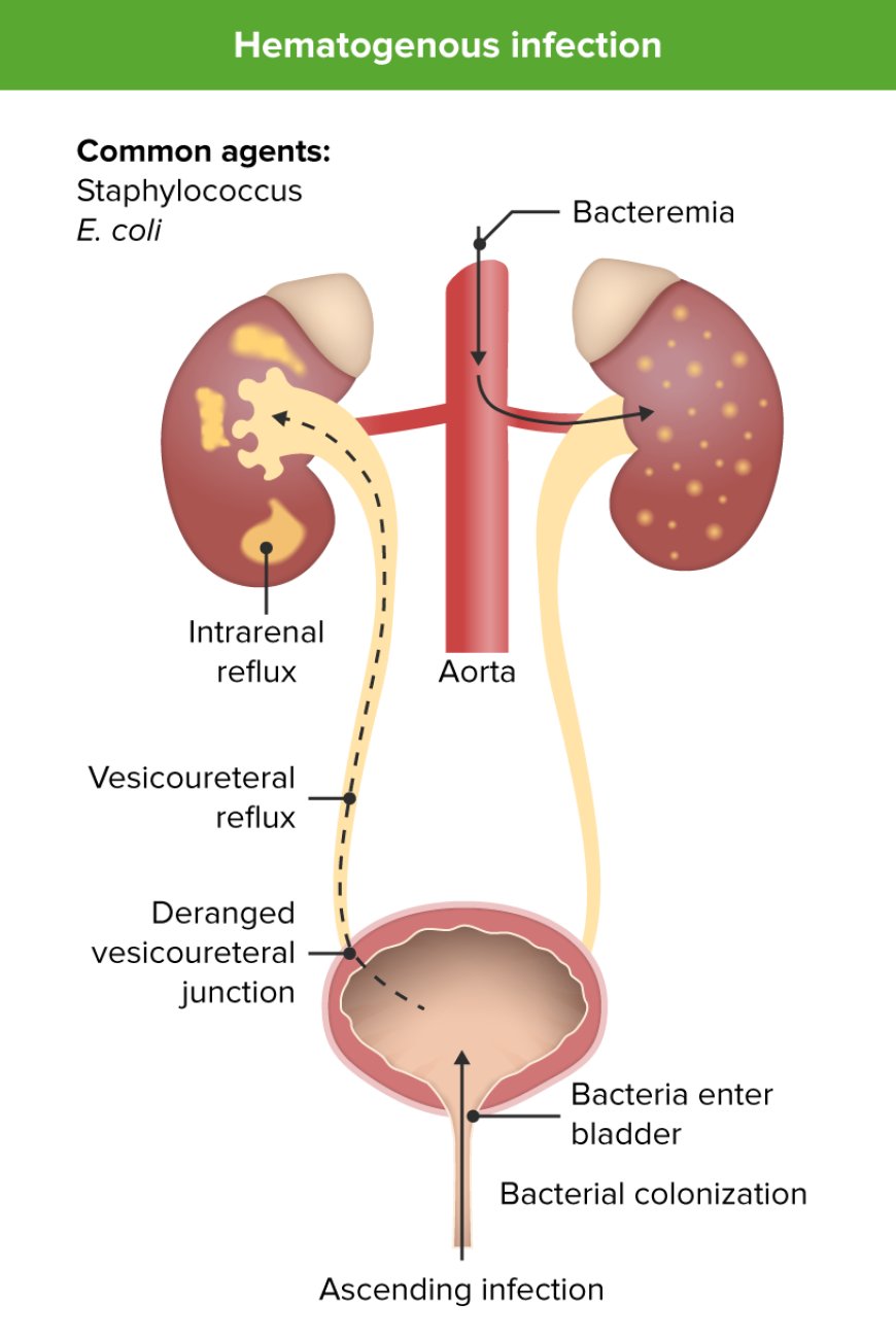 Bladder Infections in Children