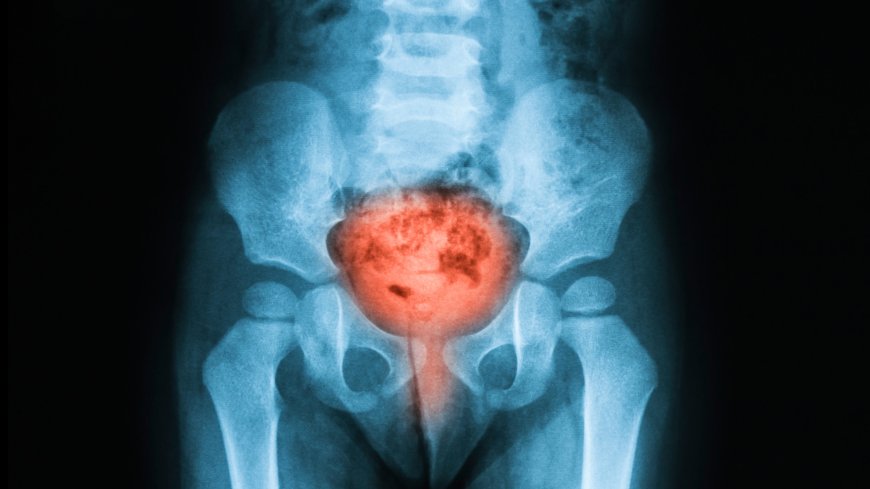 Bladder cancer