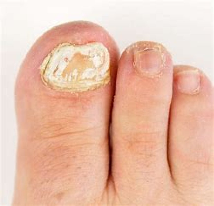 Fungal Nail Infection