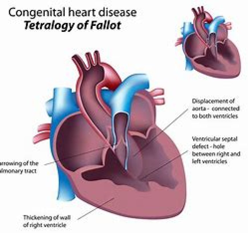 Fallot's Tetralogy