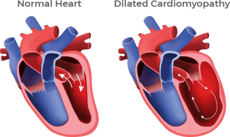 Idiopathic Dilated Cardiomyopathy