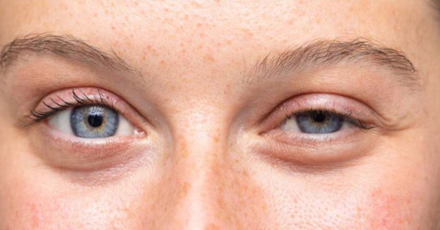 Drooping Eyelids (Ptosis)