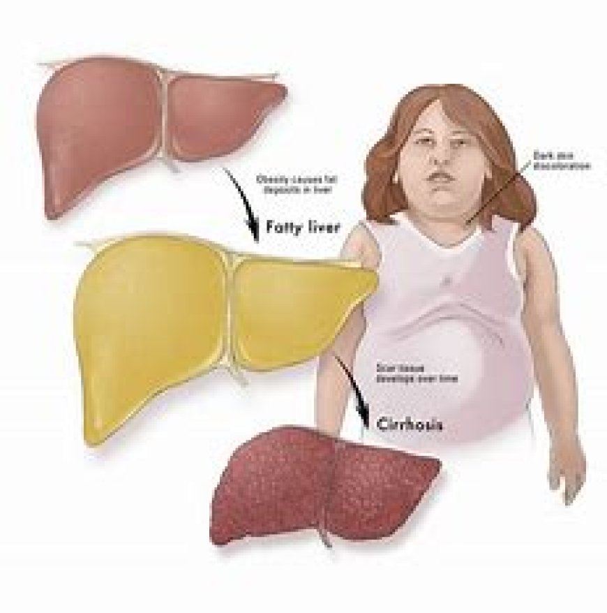 Non-Alcoholic Fatty Liver Disease