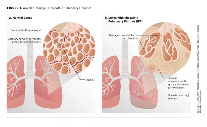 IPF (Idiopathic Pulmonary Fibrosis)