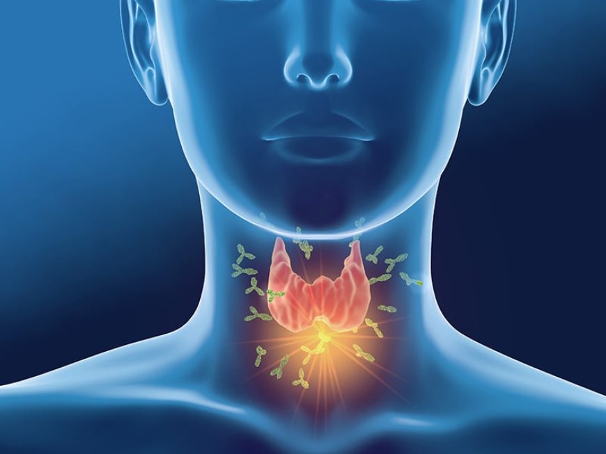 Hashimoto's Thyroiditis