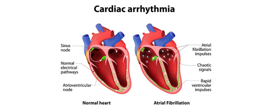 Arrhythmia