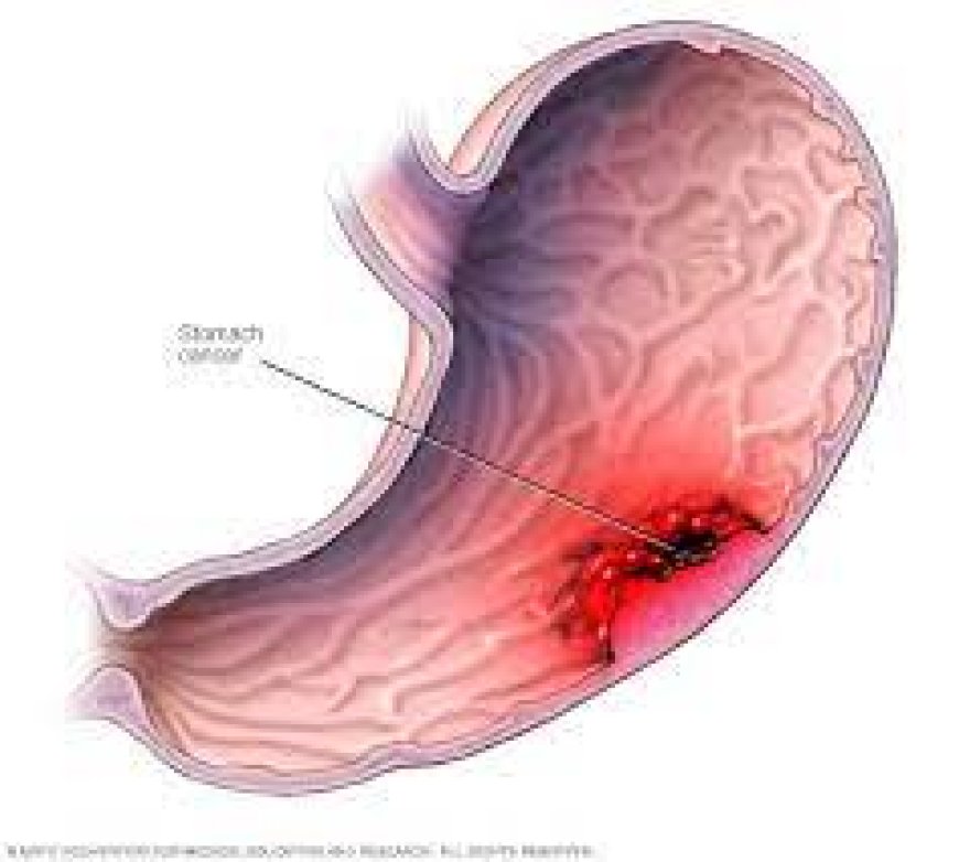 Gastric Cancer