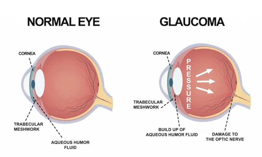 Glaucoma