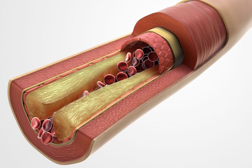 HIgh Triglycerides