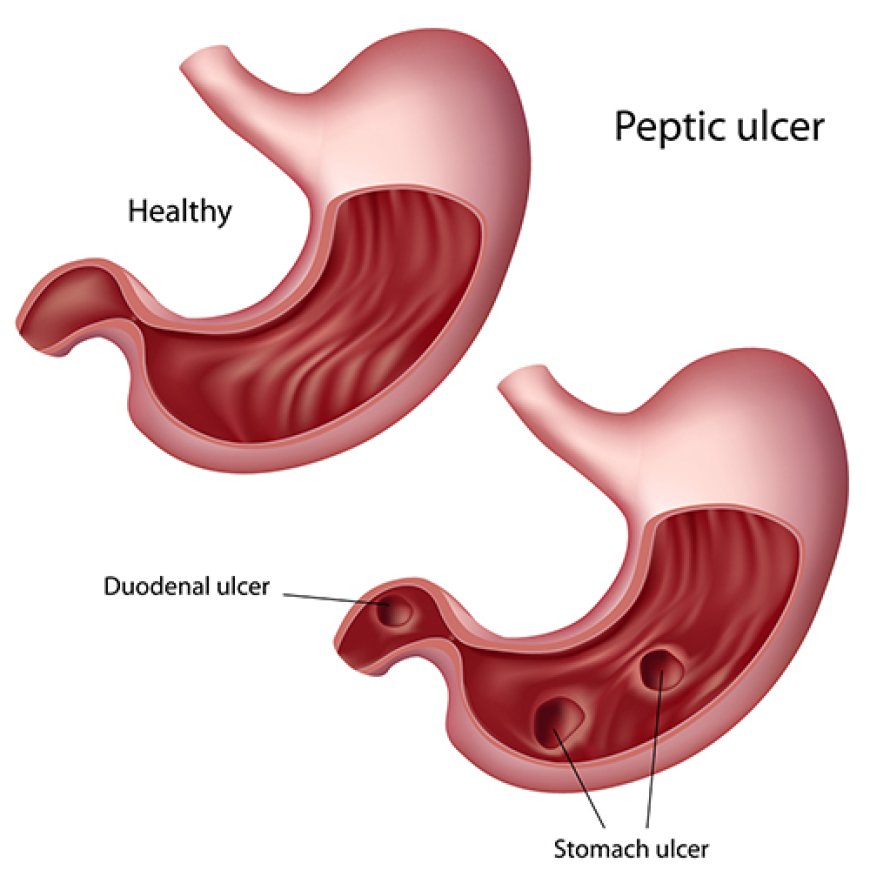 Gastric Ulcer