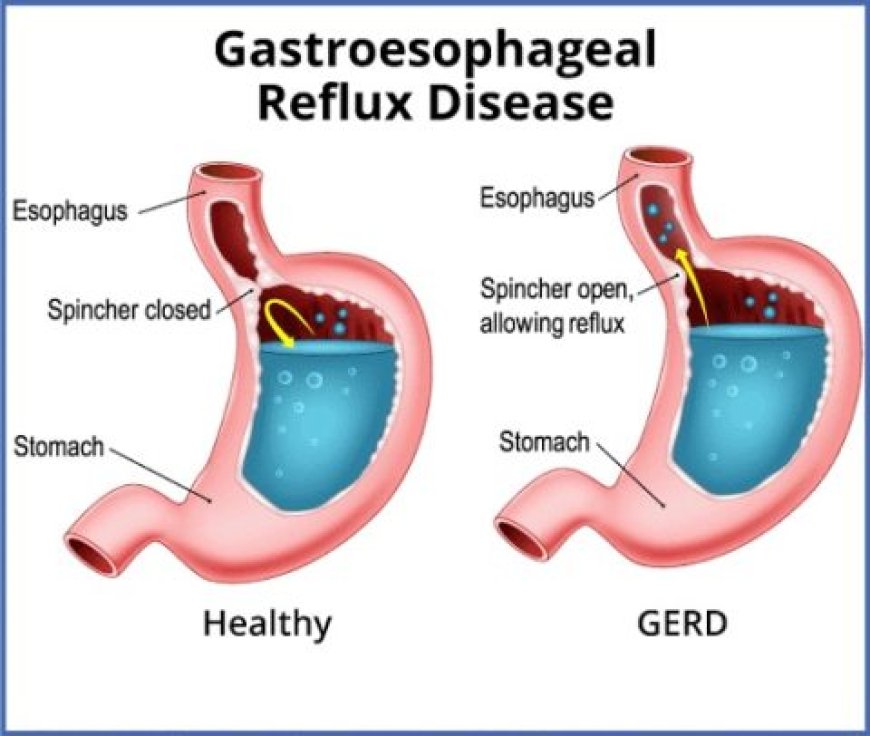 GERD (Gastroesophageal reflux disease)