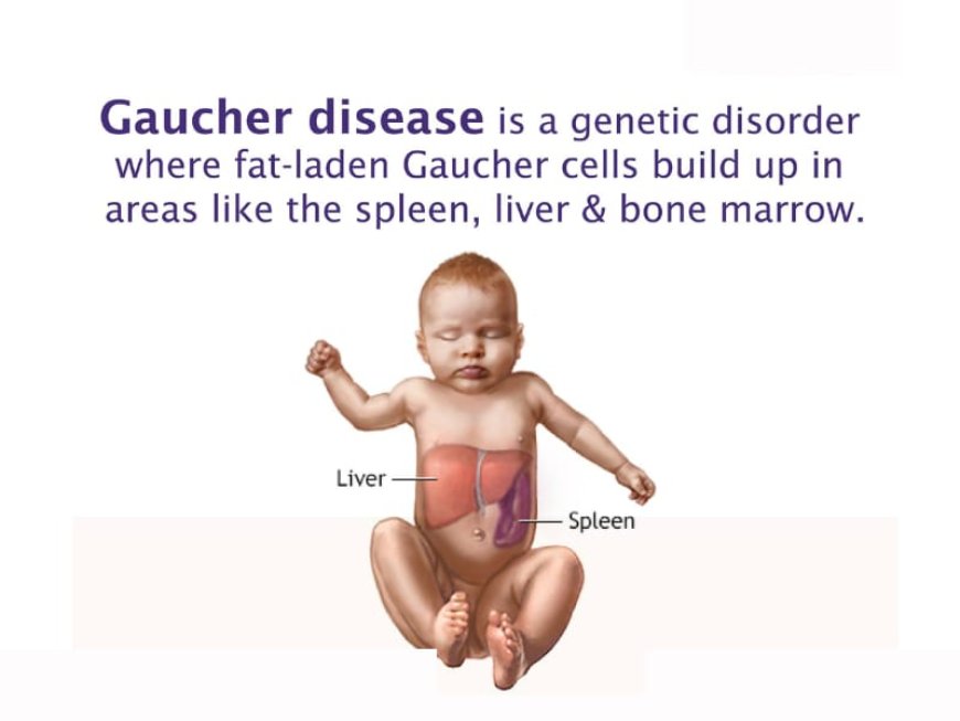 Gaucher Disease