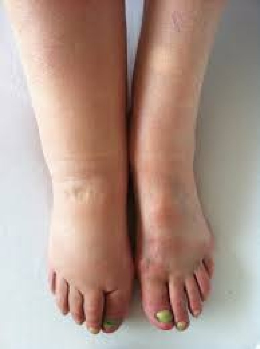 Lymphedema