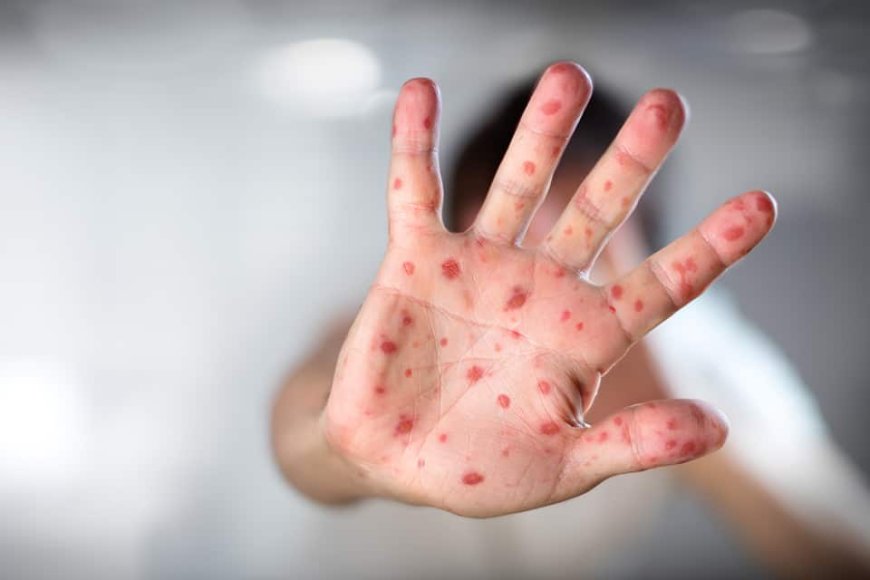 Hand-Foot-and-Mouth Disease