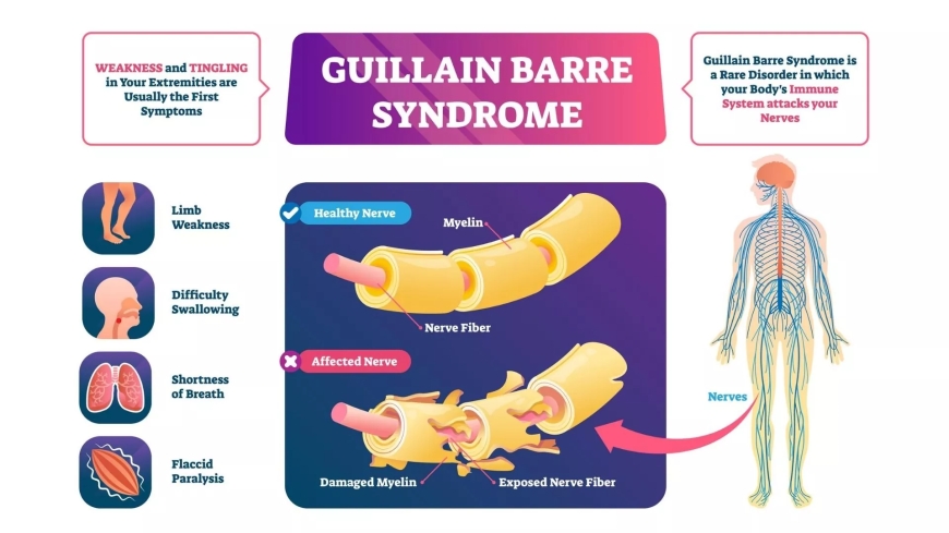 Guillain-Barre Syndrome