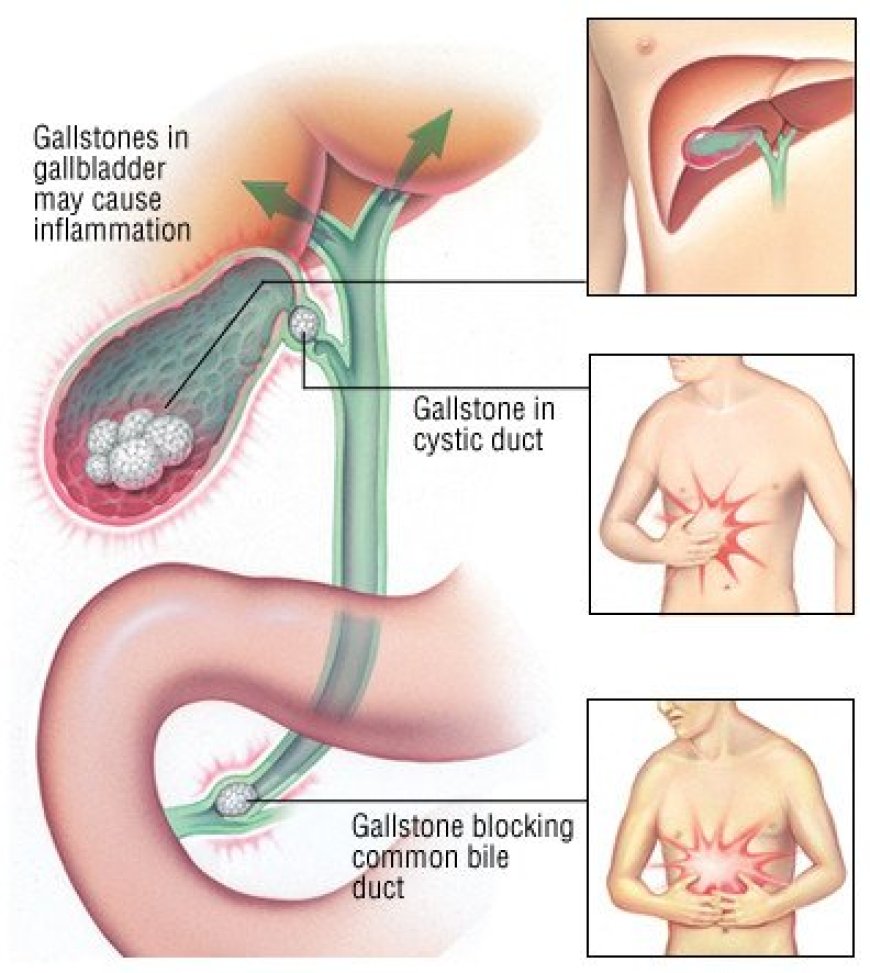 Gallbladder Inflammation