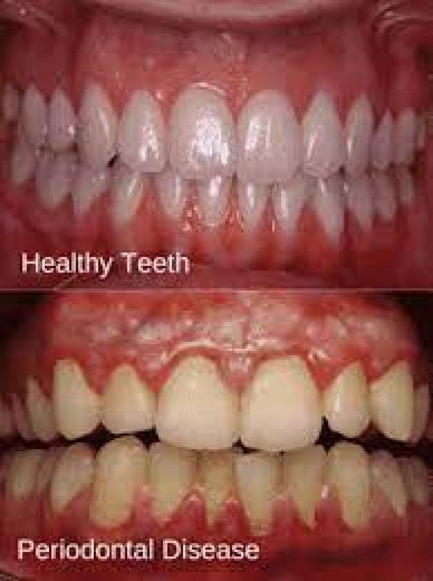 Gum Disease (Periodontitis)