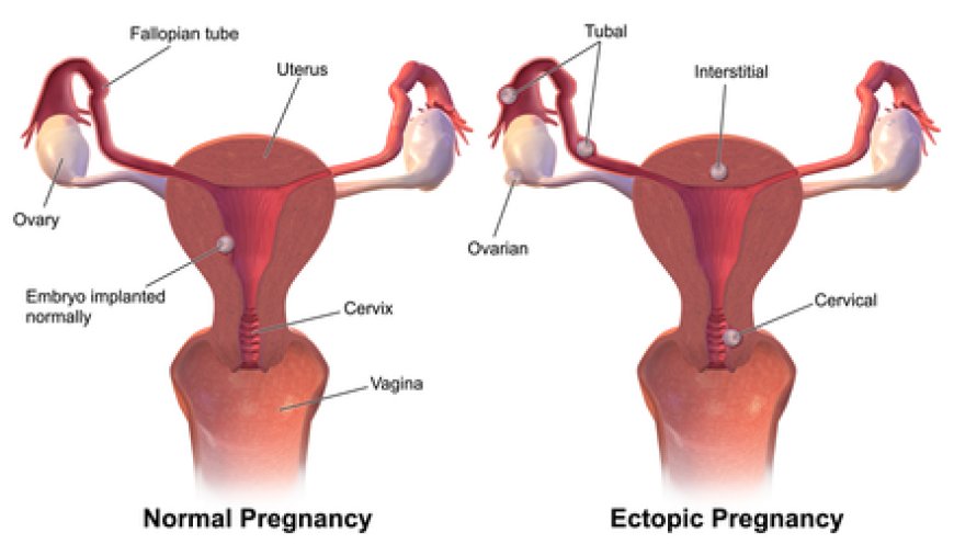 Ectopic Pregnancy