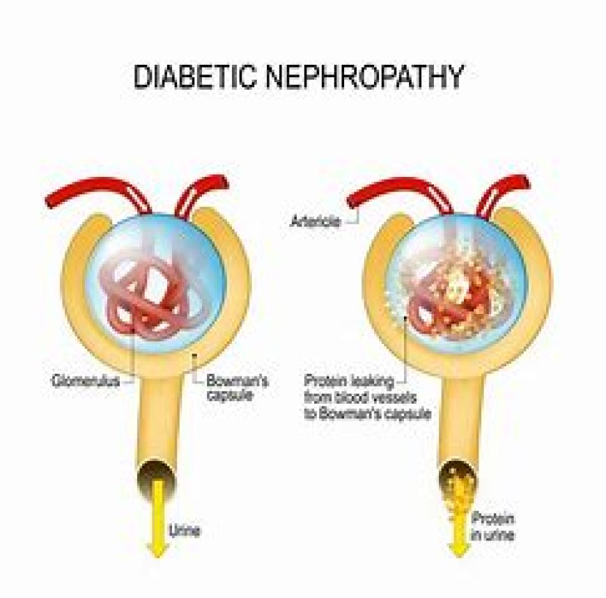 Nephropathy Diabetic