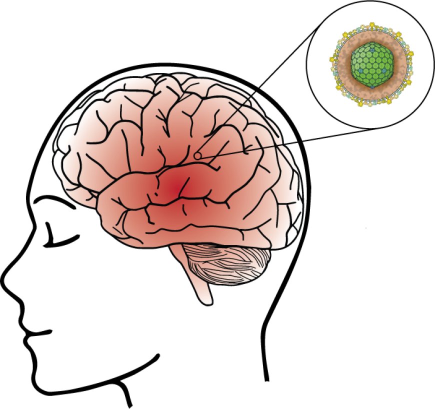 Encephalitis