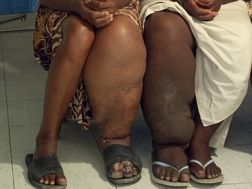 Elephantiasis