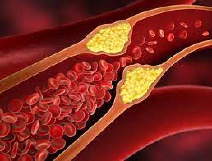 LDL Cholesterol