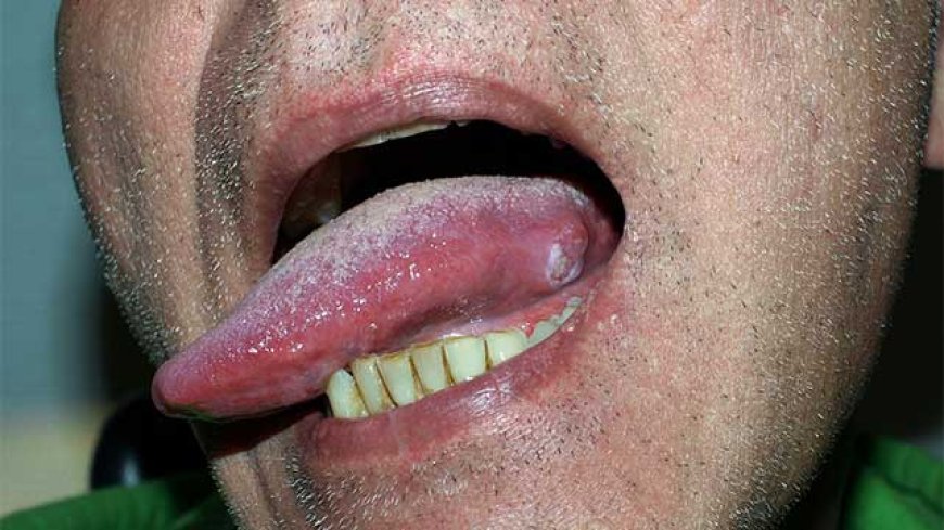 Cancer of Tongue