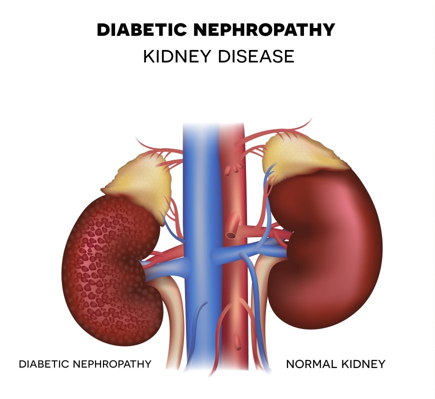 Kidney Disease - Diabetic