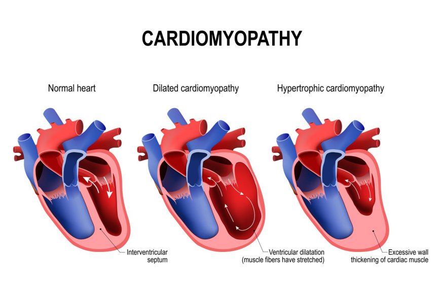 Cardiomyopathy