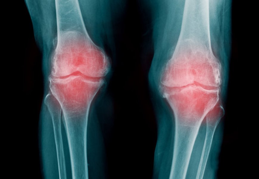 Kneecap disorder