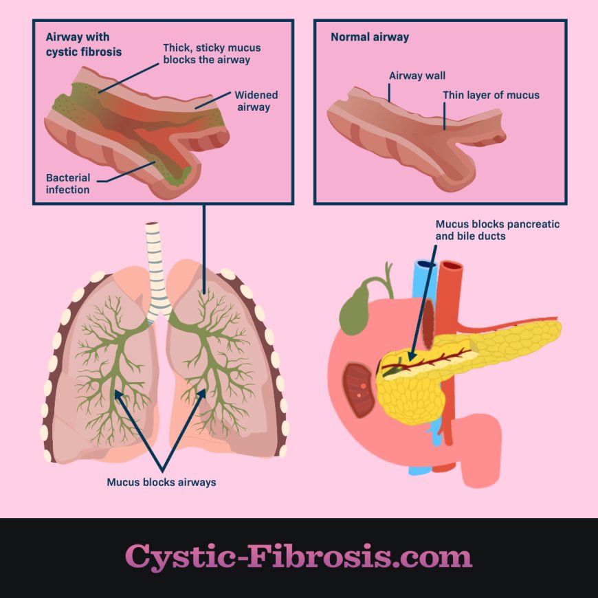 Cystic Fibrosis (CF)