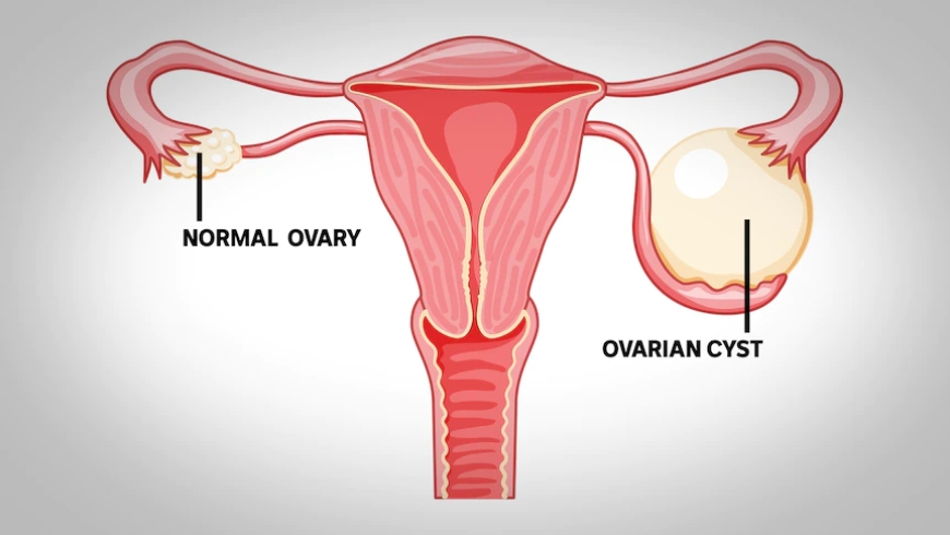 Cysts, Ovarian