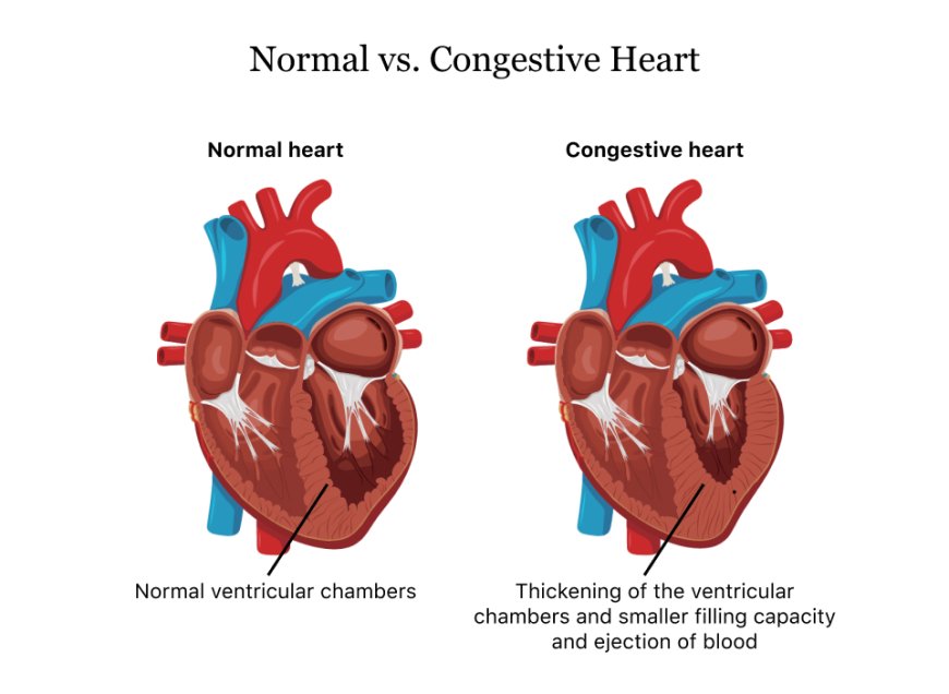 Congestive Heart Failure(CHF)