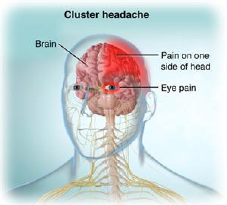 Cluster Headaches