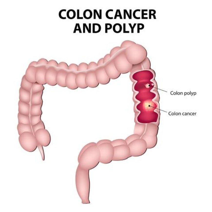 Colorectal Cancer