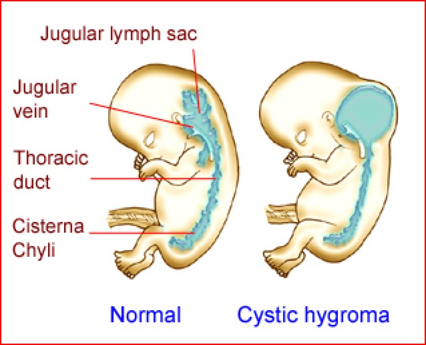 Cystic Hygroma