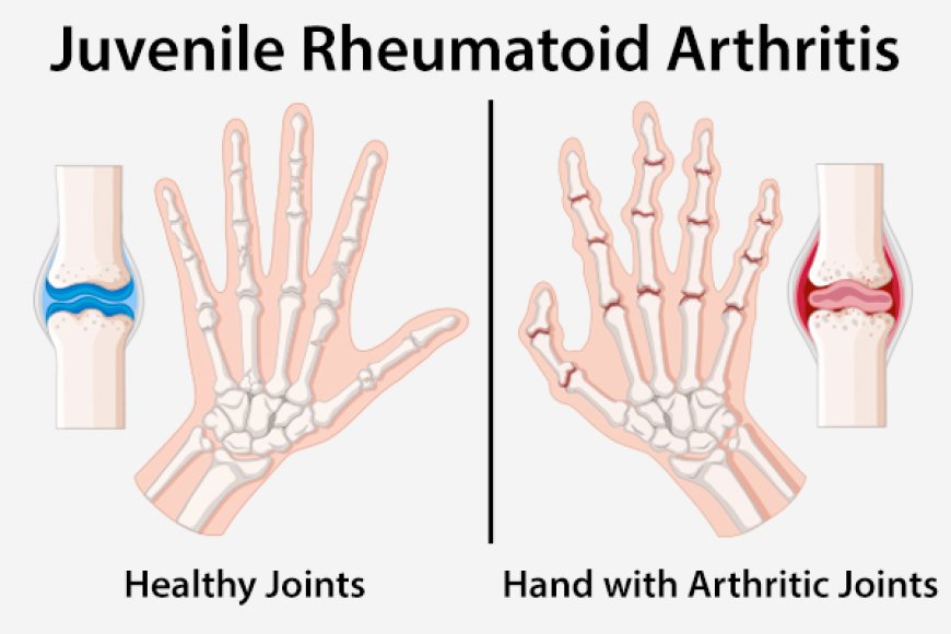 Arthritis, Juvenile Rheumatoid