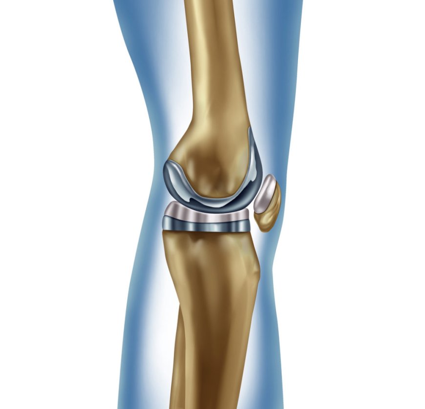 Knee Replacement Surgery